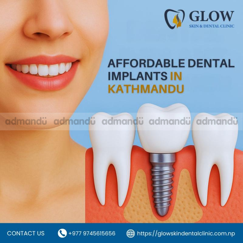 Affordable Dental Implants in Kathmandu